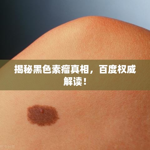 揭秘黑色素瘤真相，百度权威解读！